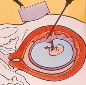 Amniocentesi e villocentesi